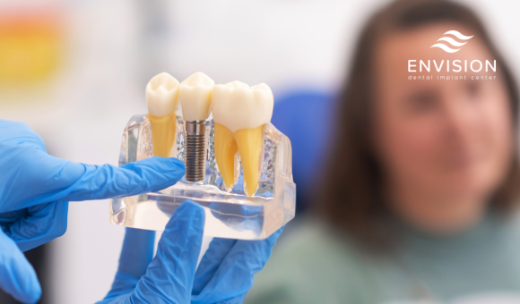 Hand with blue gloves pointing to a single dental implant and crown visual.