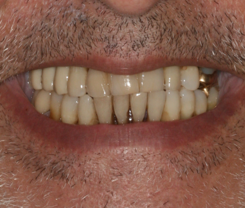 male full mouth before