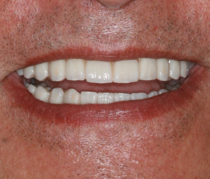 male full mouth after