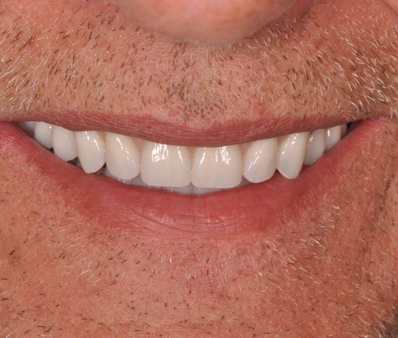 male full arch patient after