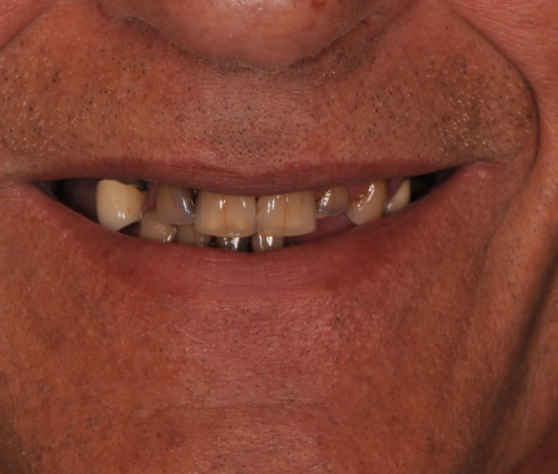 male full arch patient before