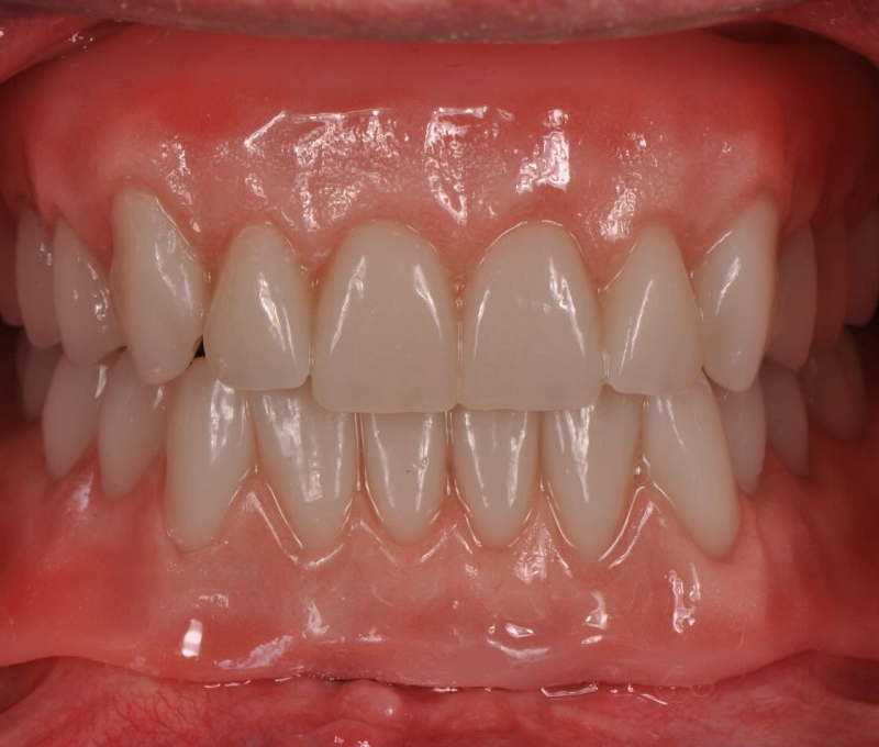 full mouth rehab after