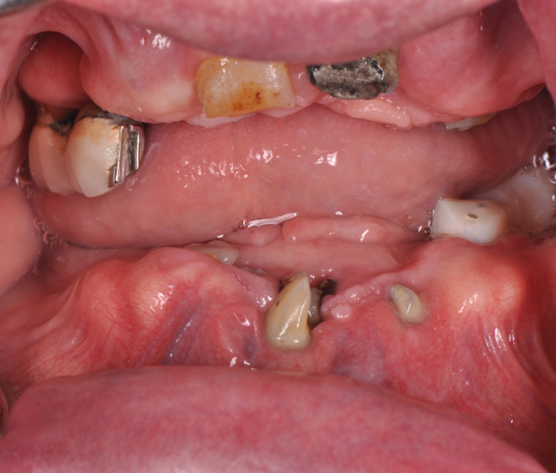 full mouth rehab before