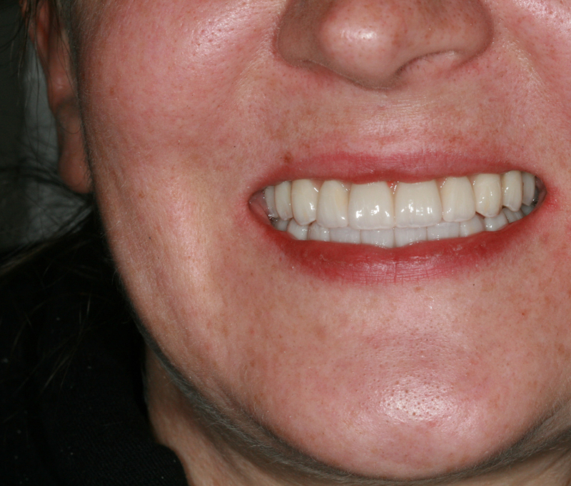 patient full mouth restoration after