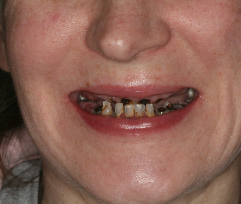 patient full mouth restoration before