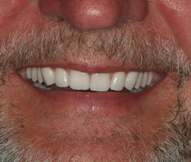 male patient full mouth restoration after