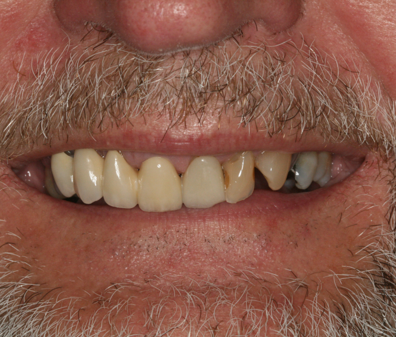 male patient full mouth restoration before