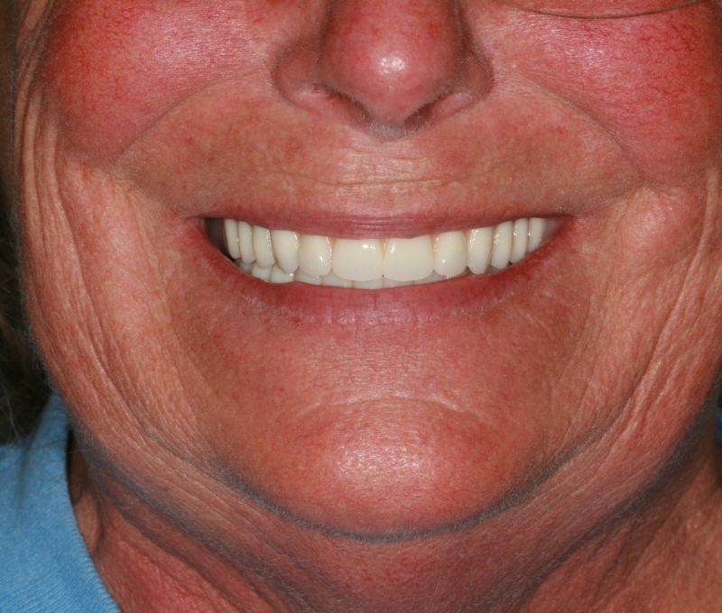 full mouth restoration patient after