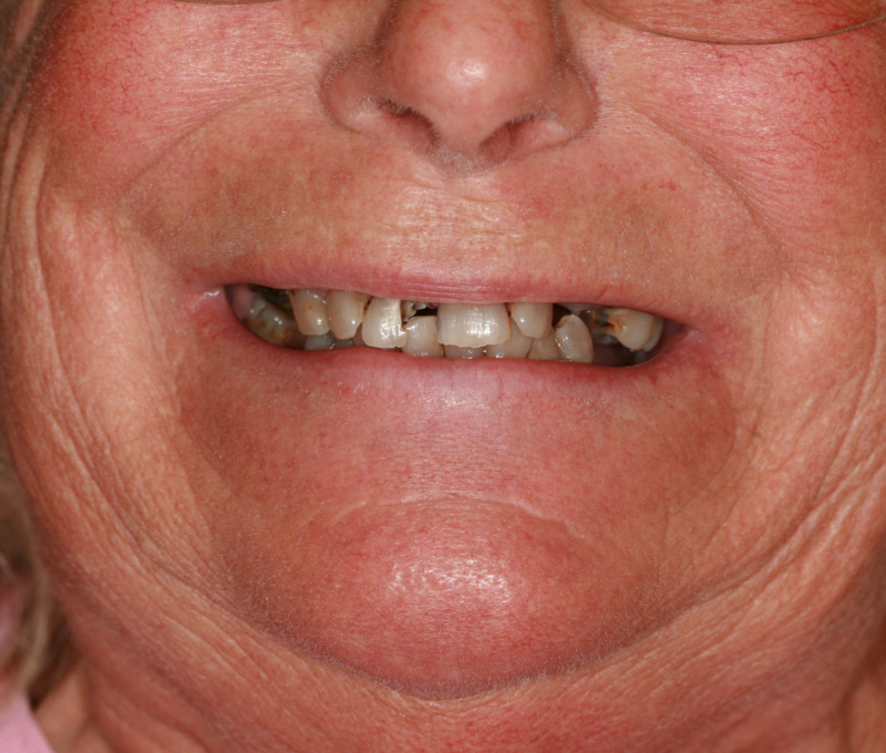 full mouth restoration patient before