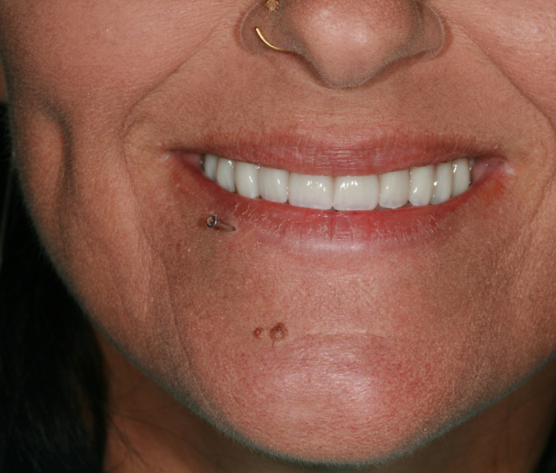 full mouth restoration after