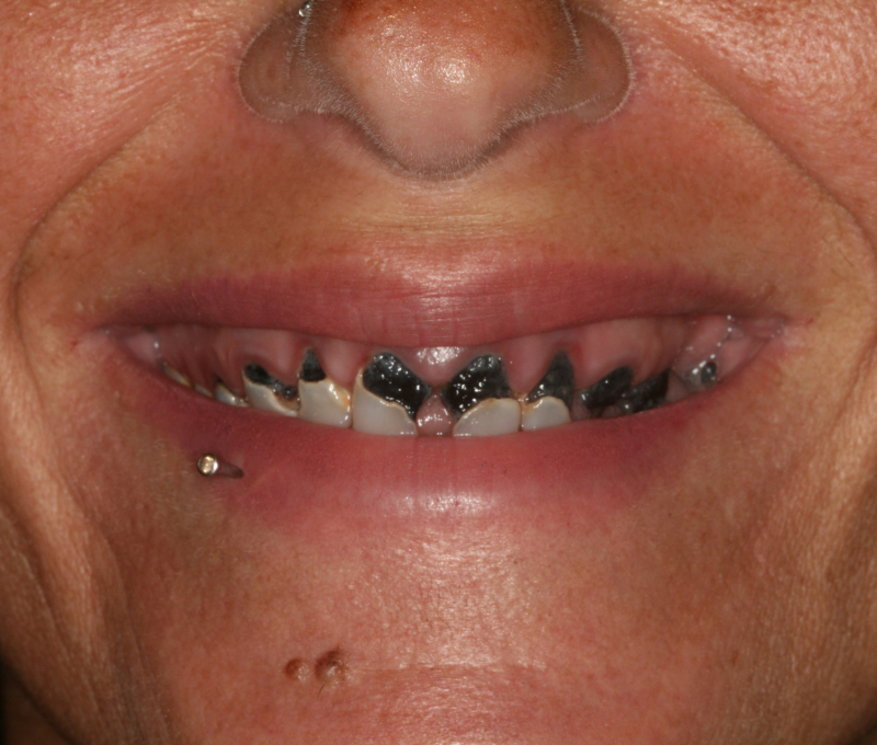 full mouth restoration before