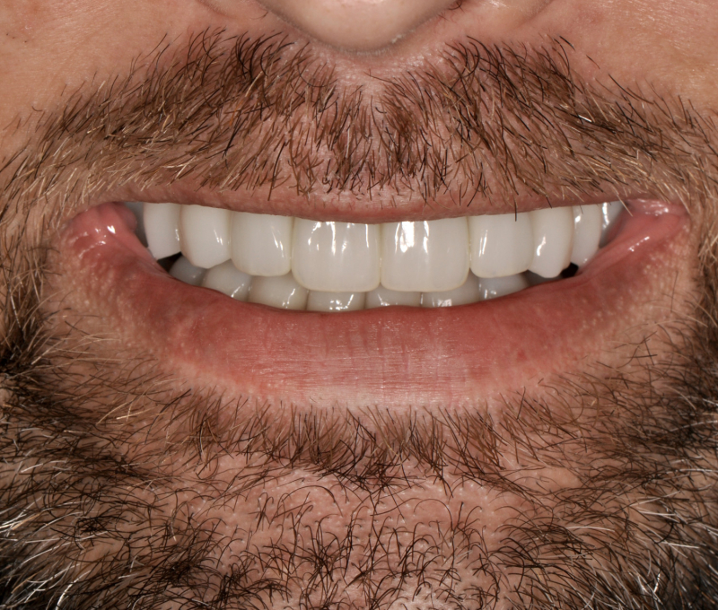 full mouth patient after