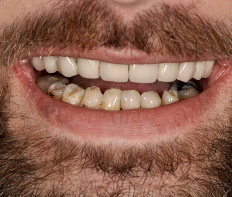 full mouth patient before