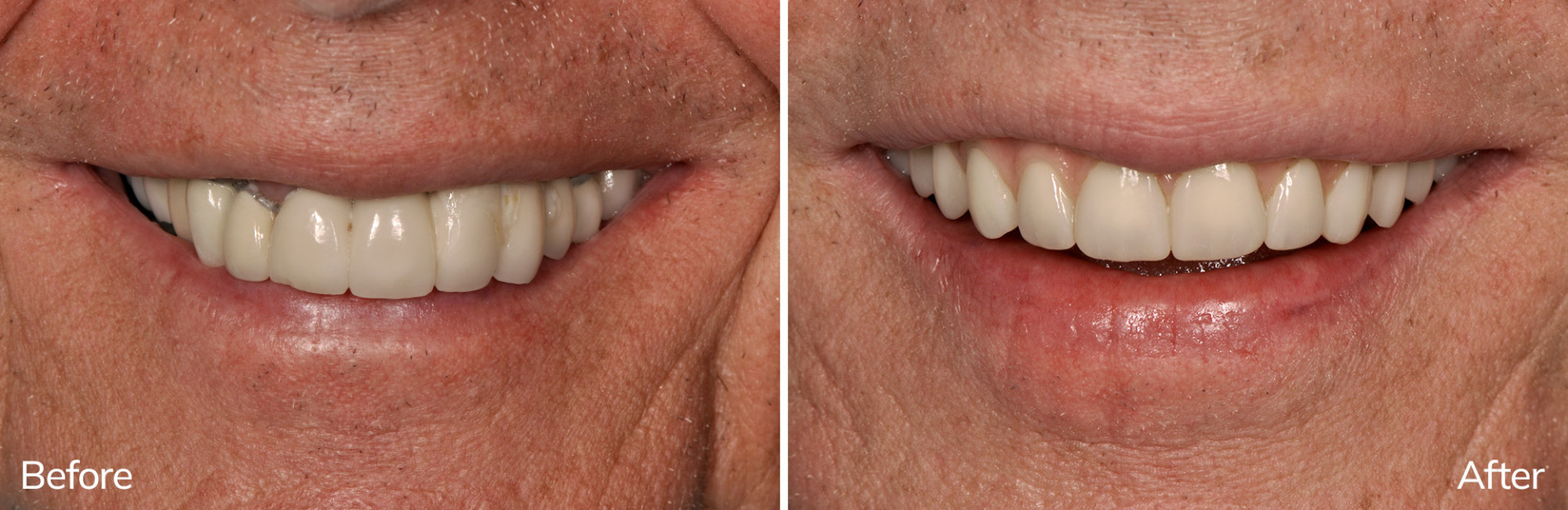 David's before and after double full-arch restoration with Envision Dental Implant Center in Charlotte, NC