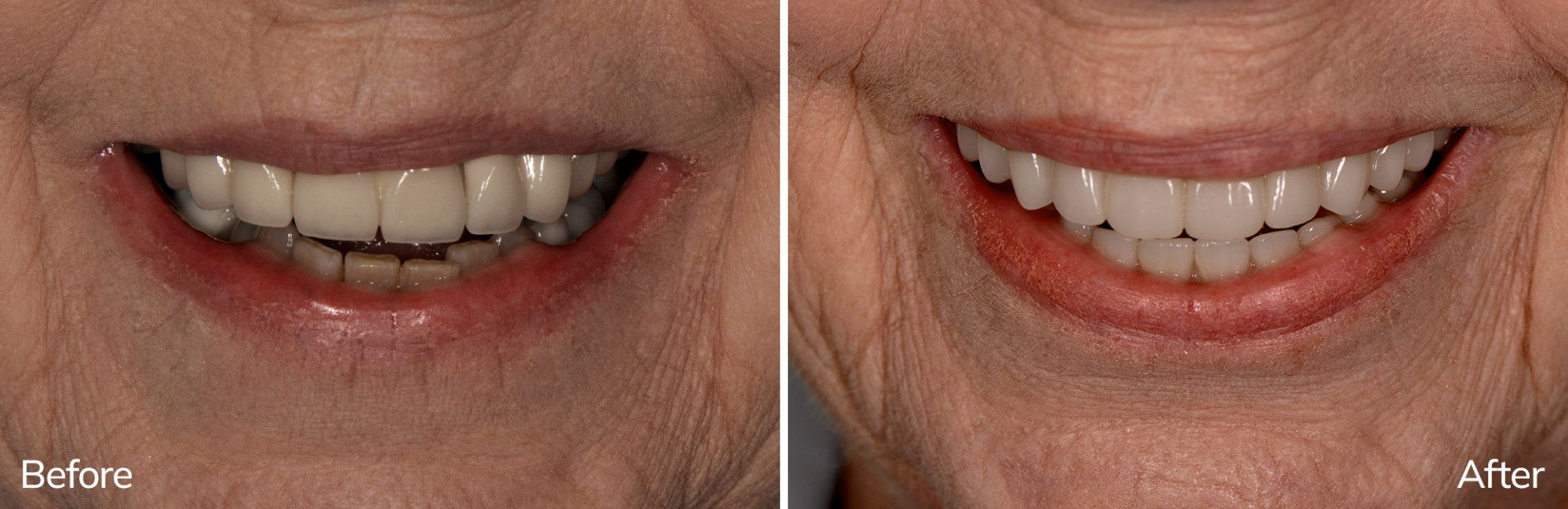 Marlene's before and after full-arch restoration replacing both upper and lower arches in Charlotte, NC