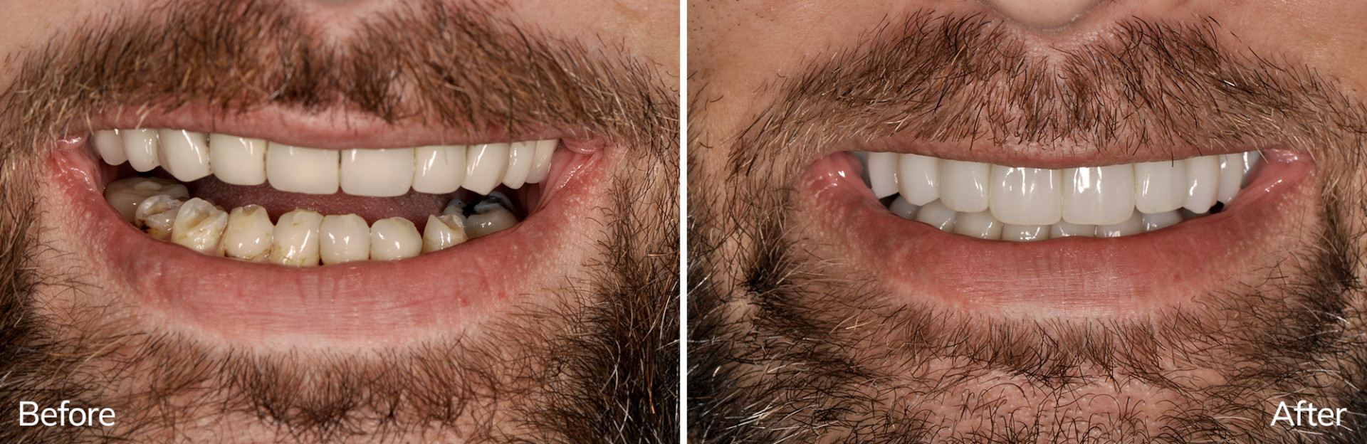 Richard's Before and After Full-Arch Restoration Treatment at Envision Dental Implant Center in Charlotte, NC