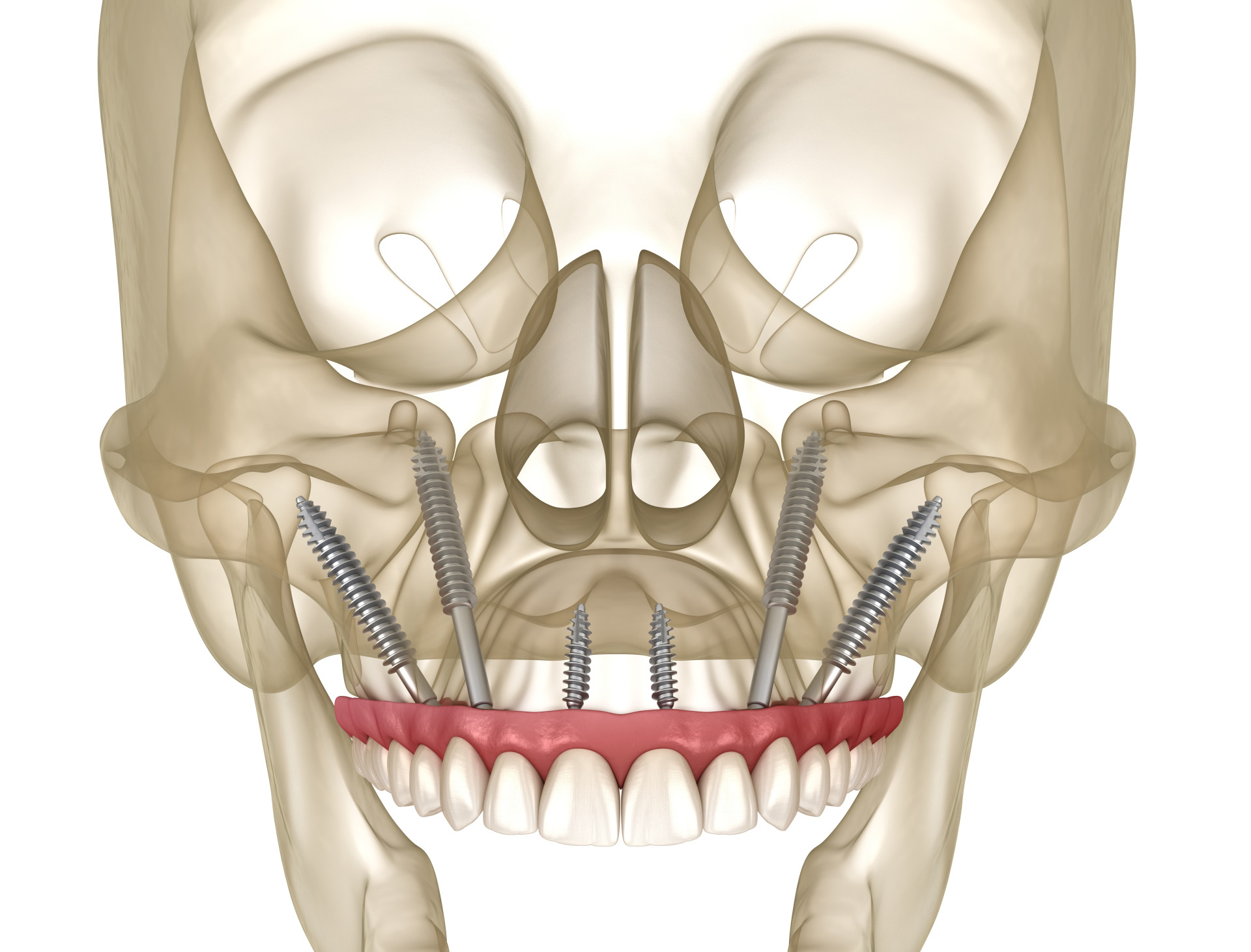 Envision Zygomatic Implants